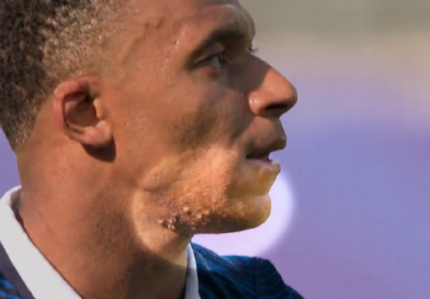 Kylian Mbappé skin rash