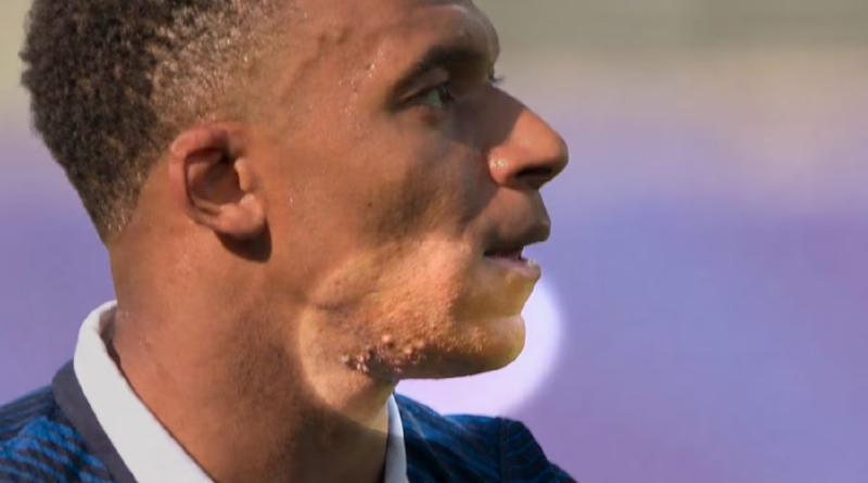Kylian Mbappé skin rash